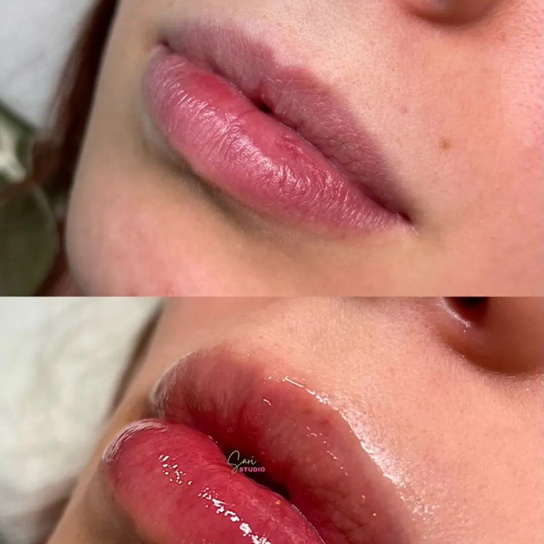 Hydralips con Dermapen